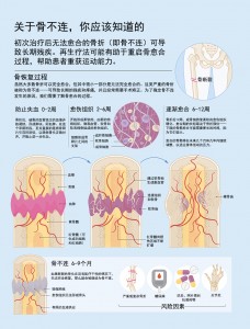 人口骨折率_腿骨折图片(2)