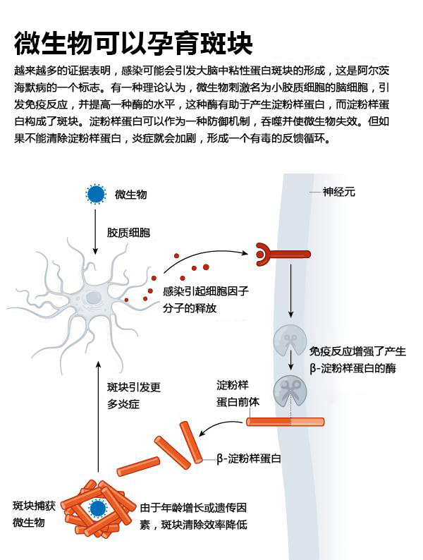 感染会引发阿尔茨海默病吗 生命奥秘 感染会引发阿尔茨海默病吗 生命奥秘