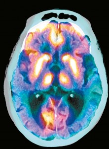 脑部扫描揭示了阿尔茨海默病造成的损伤程度