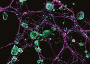 癌症劫持神经元生长及其扩散的机制-1