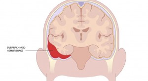 Subarachnoid Hemorrhage