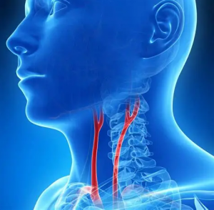 carotid artery stenosis